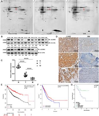 Methylation-Induced Silencing of ALDH2 Facilitates Lung Adenocarcinoma Bone Metastasis by Activating the MAPK Pathway